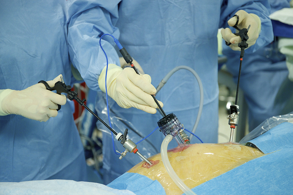 Colecistectomía laparoscópica