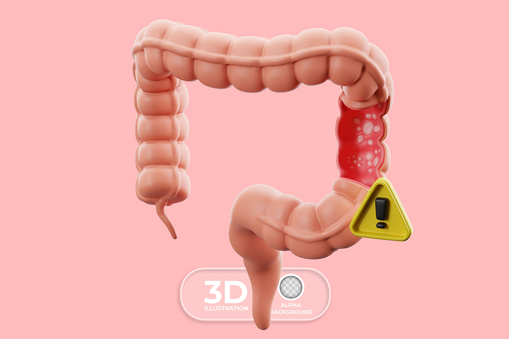 Enfermedad diverticular