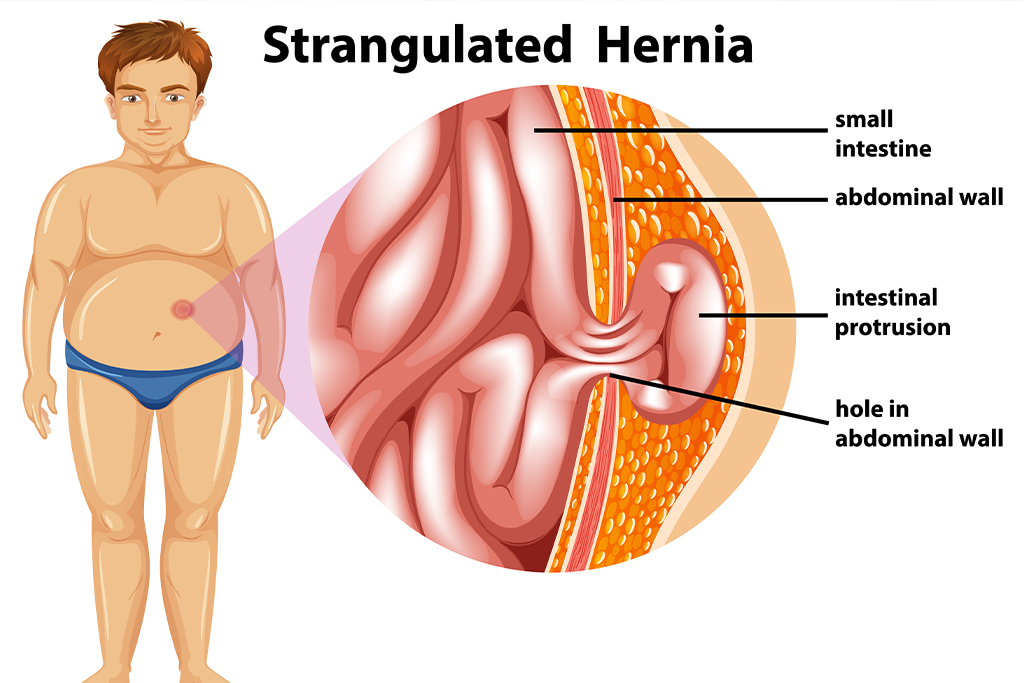 Hernias de pared abdominal